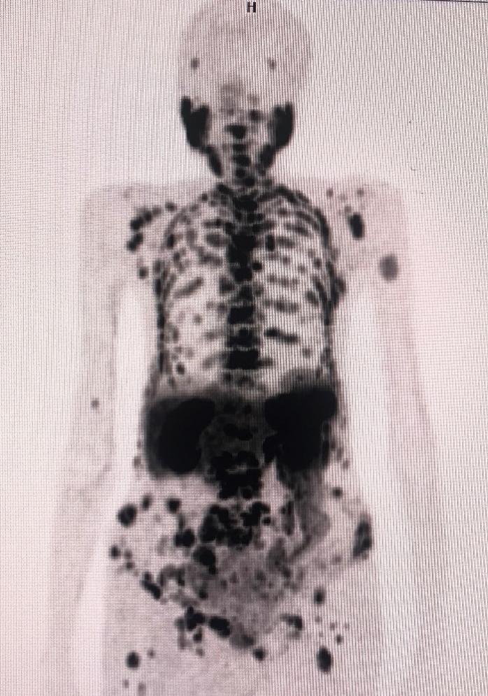 G:\LAPTOP - D\Nükleer Tıp\Nükleer Tıp case report\Yeni klasör\PSMA CT.JPG