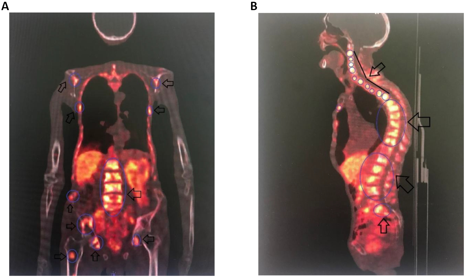 A Case Report: Application of 68 Ga-PSMA-PET/CT for the Diagnosis of ...
